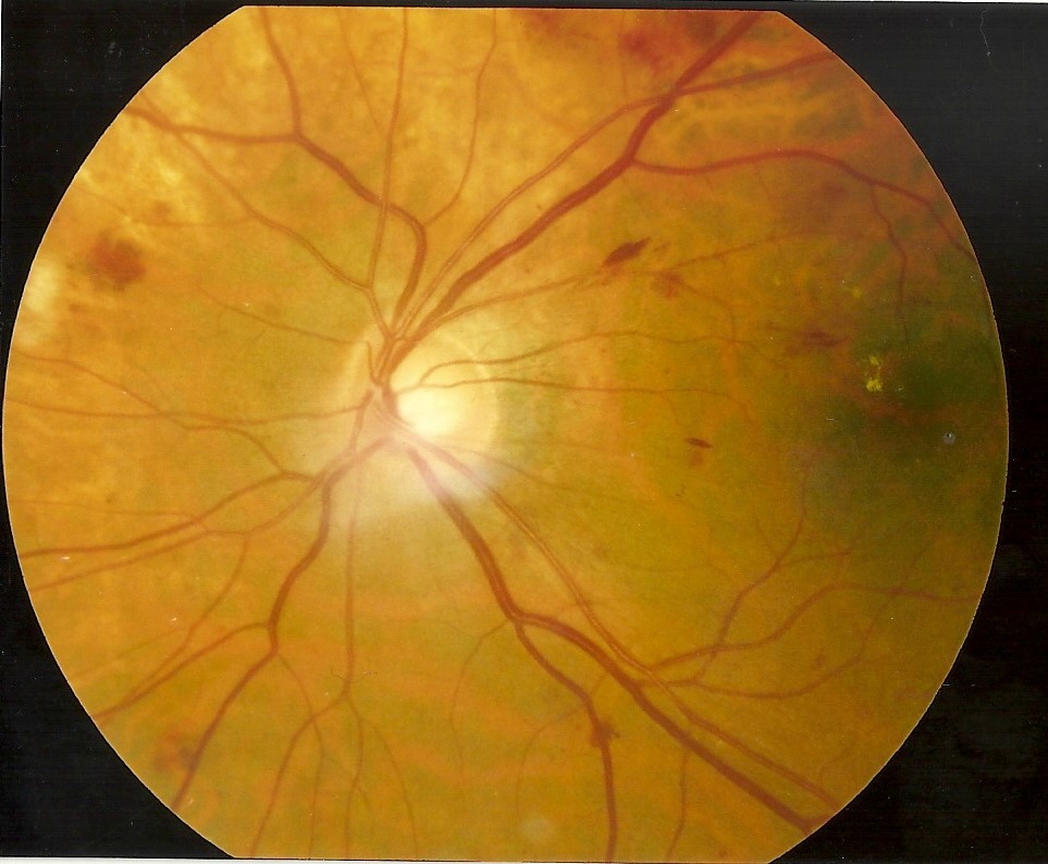 Ангиопатия сосудов сетчатки что это. Ou гипертоническая ангиопатия сетчатки. Гипертоническая ретинопатия глазное дно. Вартикозная Вена сетчатки. Диабетическая ретинопатия.